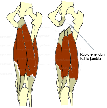anatomie_ischio_jambier_rupture proximale docteur lefevre chirurgiedusport