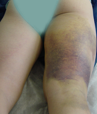 hematome cuisse rupture ischiojambier tendon