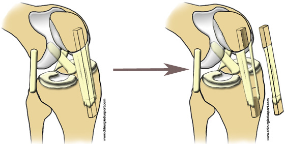 ligamentoplastie_prelevement_kj_keneth-jones_os-tendon-os_chirurgiedusport_docteur_lefevre_