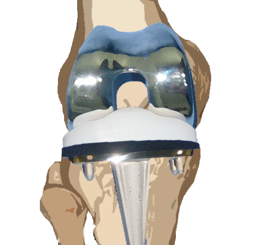 prothèse totale de genou 